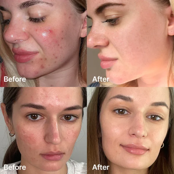 Medicube – Ser cu acid succinic pentru acnee, Red Acne Succinic Acid Peel, 40g - Imagine 3